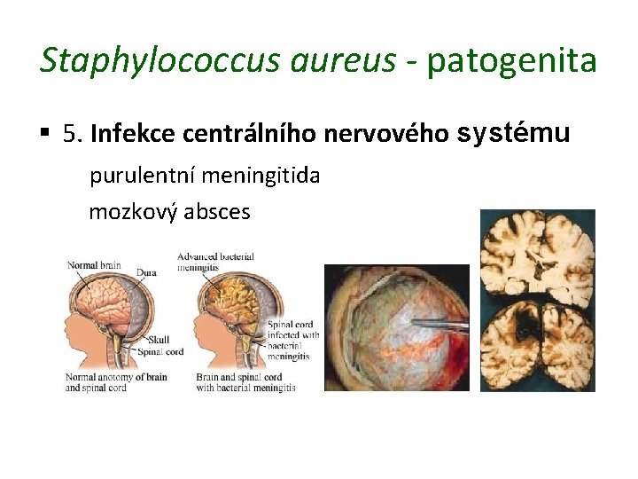 Staphylococcus aureus - patogenita § 5. Infekce centrálního nervového systému purulentní meningitida mozkový absces