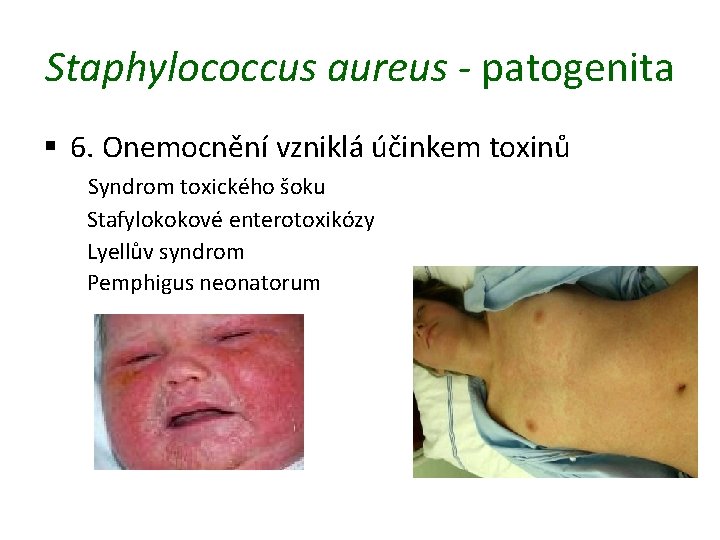 Staphylococcus aureus - patogenita § 6. Onemocnění vzniklá účinkem toxinů Syndrom toxického šoku Stafylokokové