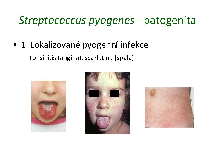 Streptococcus pyogenes - patogenita § 1. Lokalizované pyogenní infekce tonsillitis (angína), scarlatina (spála) 