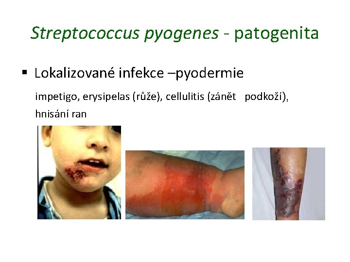 Streptococcus pyogenes - patogenita § Lokalizované infekce –pyodermie impetigo, erysipelas (růže), cellulitis (zánět podkoží),