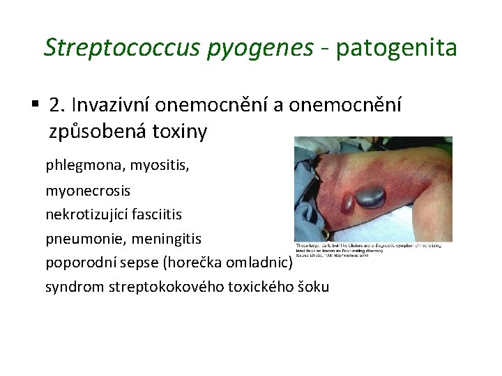 Streptococcus pyogenes - patogenita § 2. Invazivní onemocnění a onemocnění způsobená toxiny phlegmona, myositis,