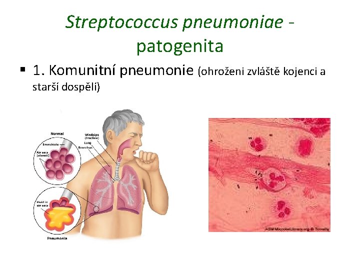 Streptococcus pneumoniae patogenita § 1. Komunitní pneumonie (ohroženi zvláště kojenci a starší dospělí) 