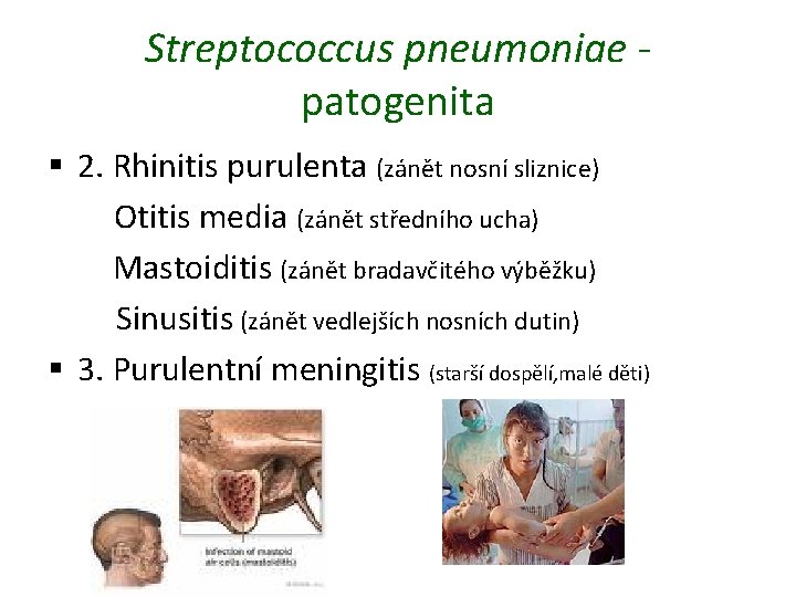 Streptococcus pneumoniae patogenita § 2. Rhinitis purulenta (zánět nosní sliznice) Otitis media (zánět středního