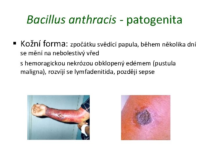 Bacillus anthracis - patogenita § Kožní forma: zpočátku svědící papula, během několika dní se