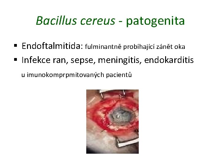 Bacillus cereus - patogenita § Endoftalmitida: fulminantně probíhající zánět oka § Infekce ran, sepse,