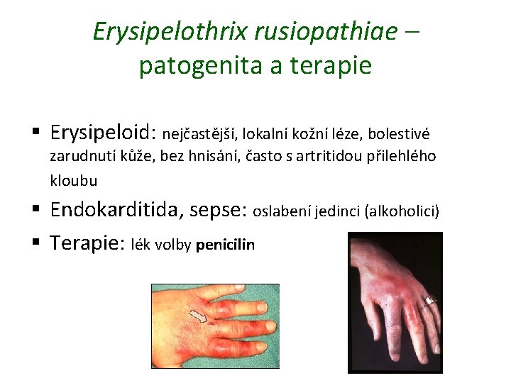 Erysipelothrix rusiopathiae – patogenita a terapie § Erysipeloid: nejčastější, lokalní kožní léze, bolestivé zarudnutí