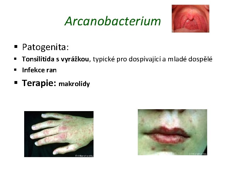 Arcanobacterium § Patogenita: § Tonsilitida s vyrážkou, typické pro dospívající a mladé dospělé §