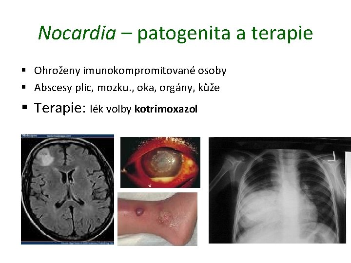 Nocardia – patogenita a terapie § Ohroženy imunokompromitované osoby § Abscesy plic, mozku. ,