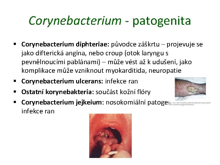 Corynebacterium - patogenita § Corynebacterium diphteriae: původce záškrtu – projevuje se jako difterická angína,