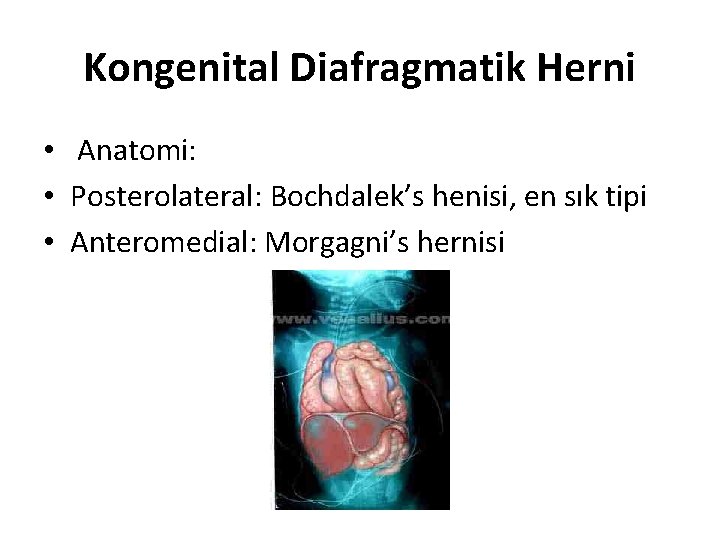 Kongenital Diafragmatik Herni • Anatomi: • Posterolateral: Bochdalek’s henisi, en sık tipi • Anteromedial: