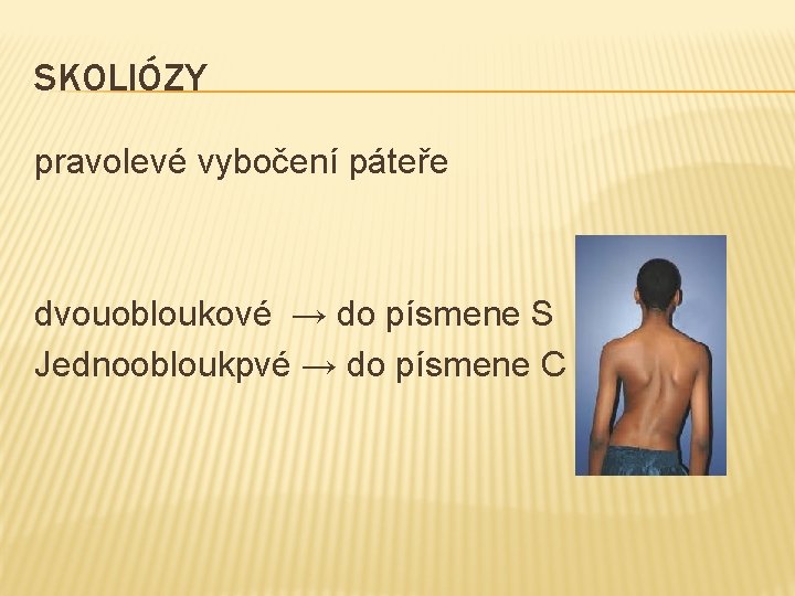 SKOLIÓZY pravolevé vybočení páteře dvouobloukové → do písmene S Jednoobloukpvé → do písmene C