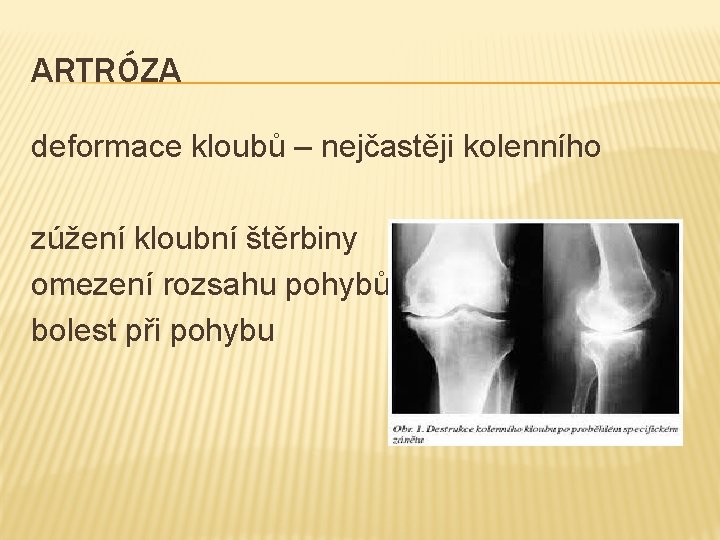 ARTRÓZA deformace kloubů – nejčastěji kolenního zúžení kloubní štěrbiny omezení rozsahu pohybů bolest při