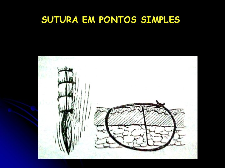 SUTURA EM PONTOS SIMPLES 