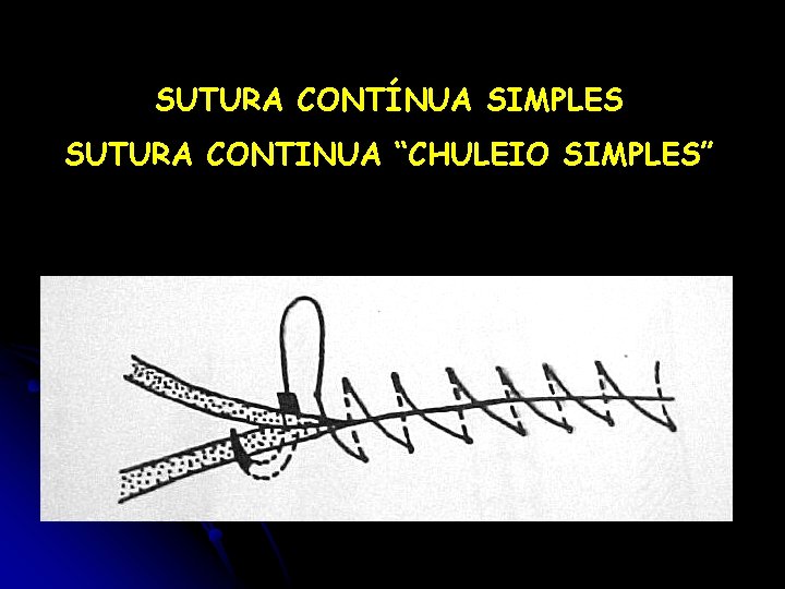 SUTURA CONTÍNUA SIMPLES SUTURA CONTINUA “CHULEIO SIMPLES” 