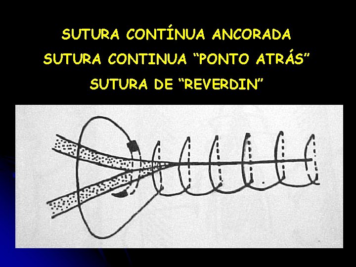 SUTURA CONTÍNUA ANCORADA SUTURA CONTINUA “PONTO ATRÁS” SUTURA DE “REVERDIN” 