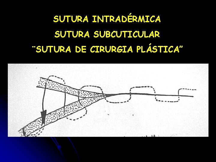 SUTURA INTRADÉRMICA SUTURA SUBCUTICULAR ¨SUTURA DE CIRURGIA PLÁSTICA” 