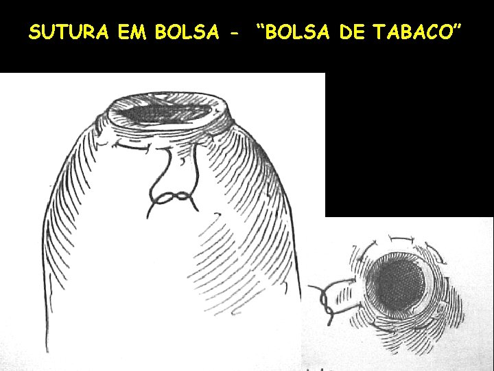 SUTURA EM BOLSA - “BOLSA DE TABACO” 