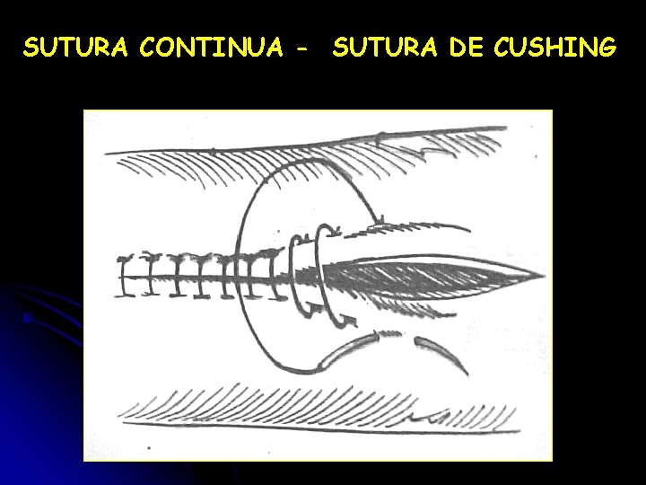 SUTURA CONTINUA - SUTURA DE CUSHING 