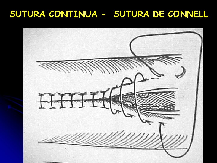 SUTURA CONTINUA - SUTURA DE CONNELL 