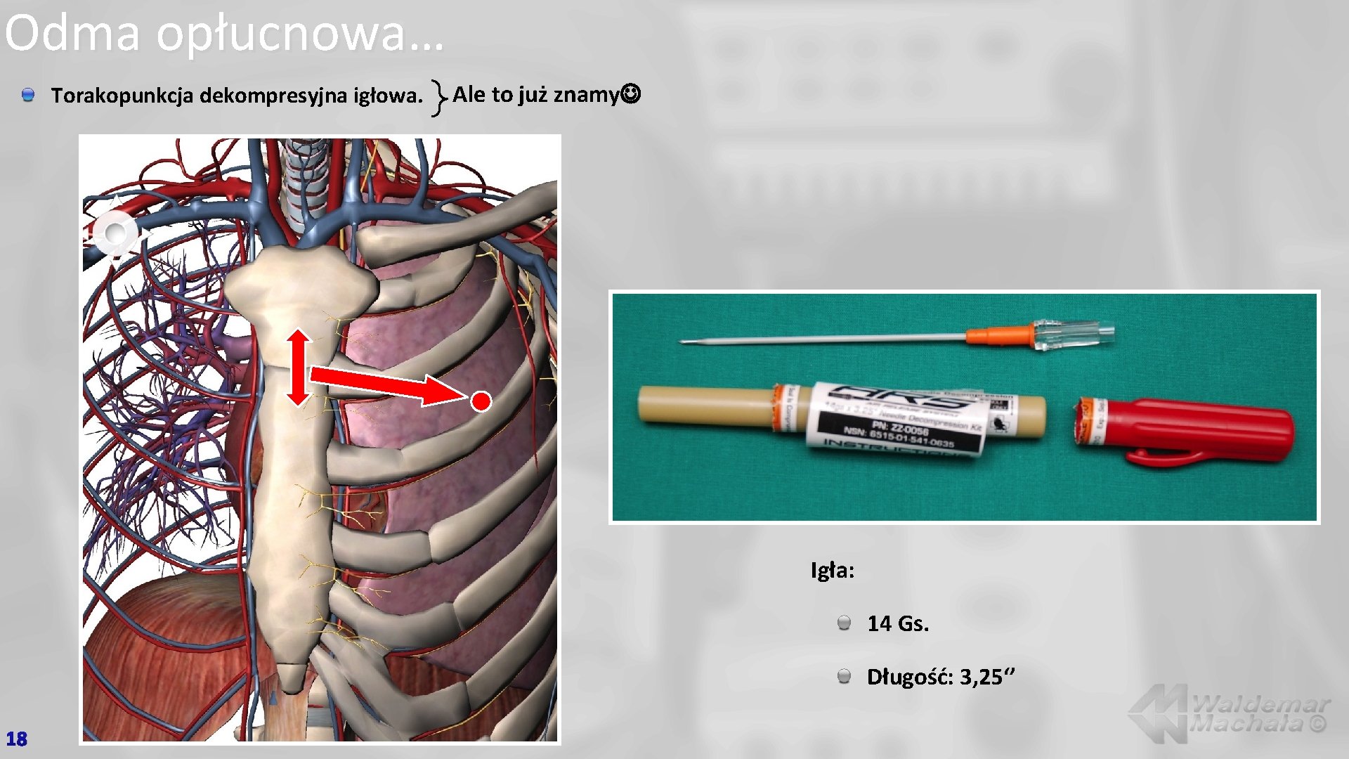 Odma opłucnowa… Torakopunkcja dekompresyjna igłowa. Ale to już znamy Igła: 14 Gs. Długość: 3,