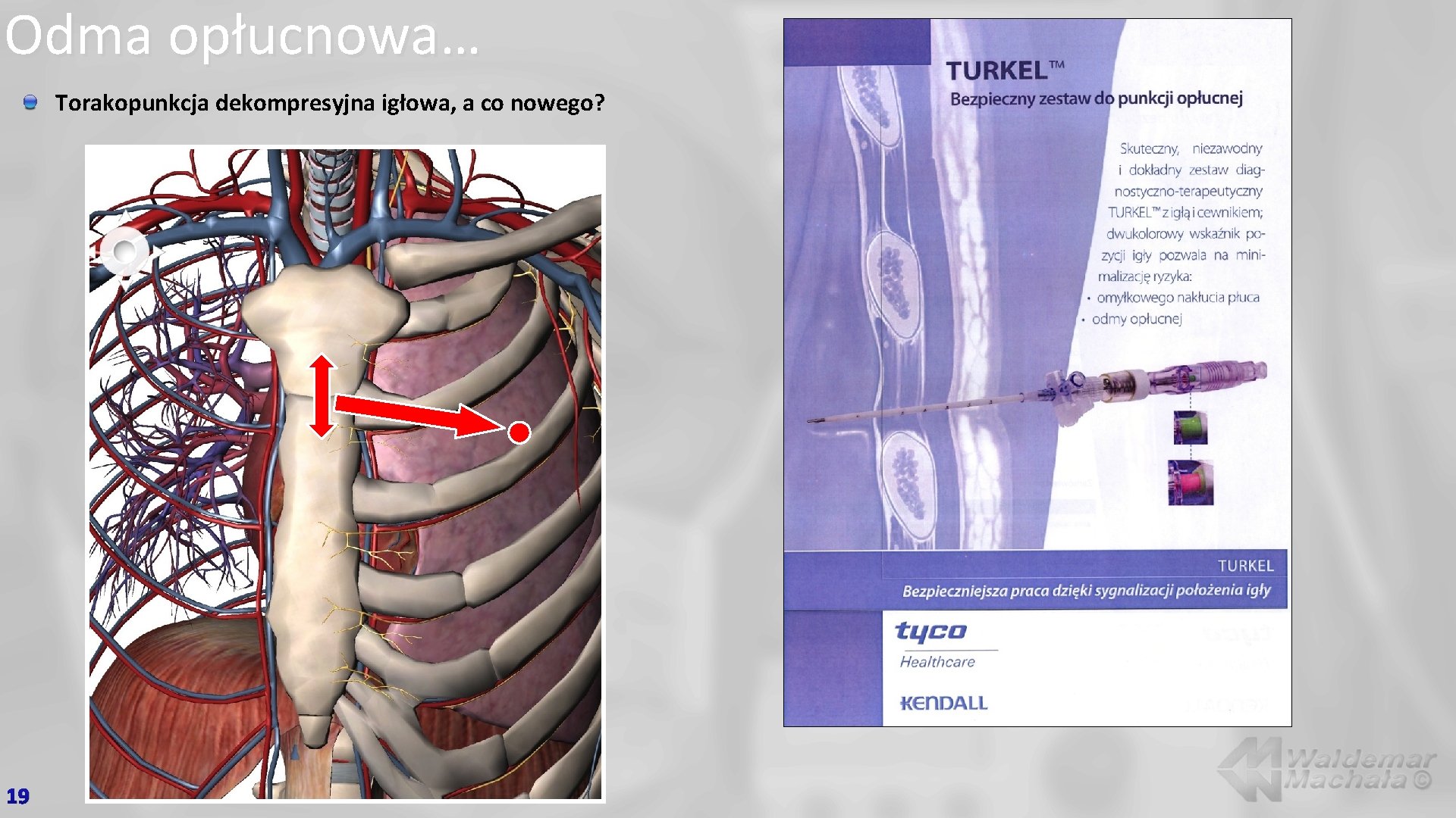 Odma opłucnowa… Torakopunkcja dekompresyjna igłowa, a co nowego? 19 
