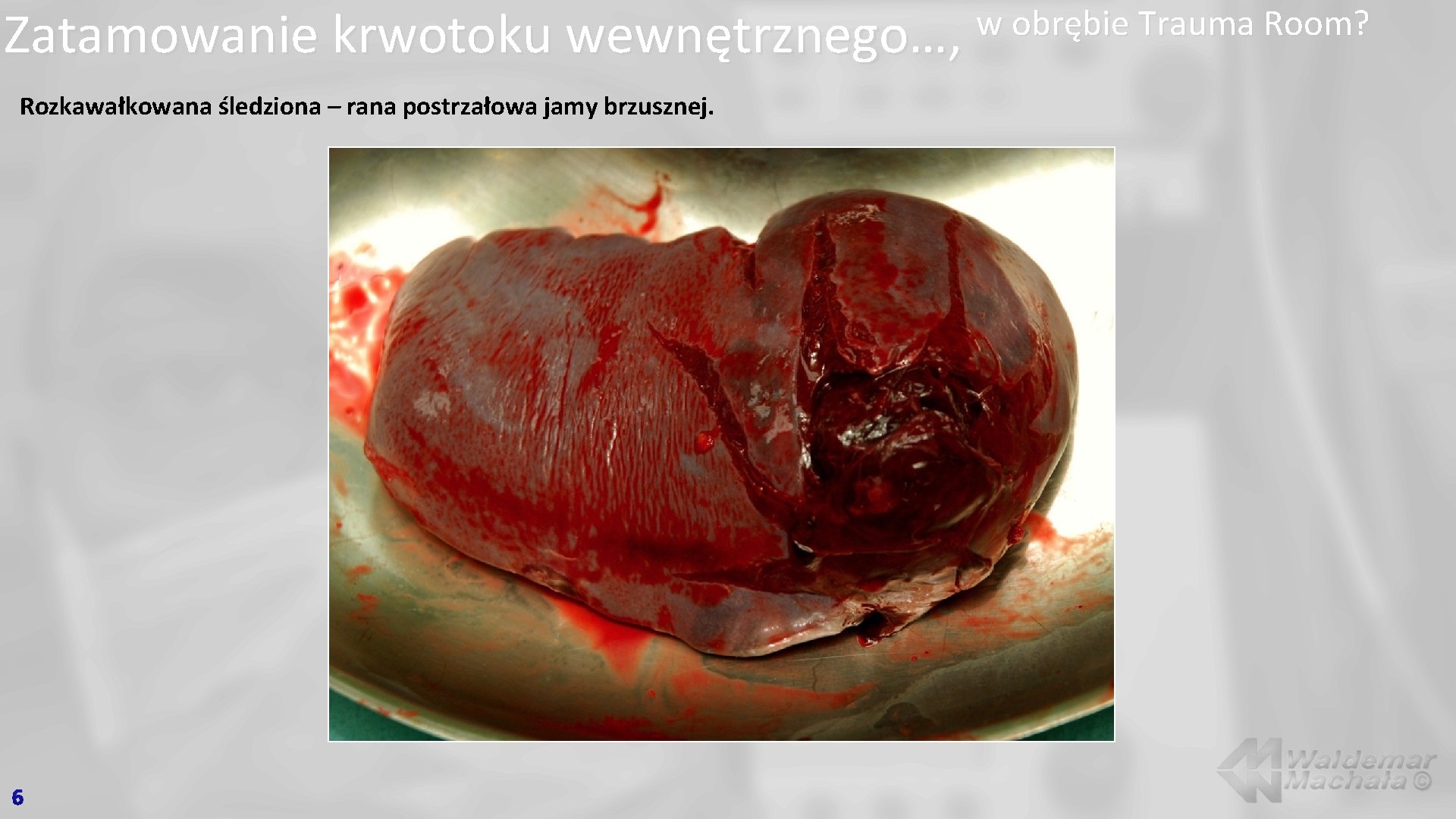 Zatamowanie krwotoku wewnętrznego…, Rozkawałkowana śledziona – rana postrzałowa jamy brzusznej. 6 w obrębie Trauma