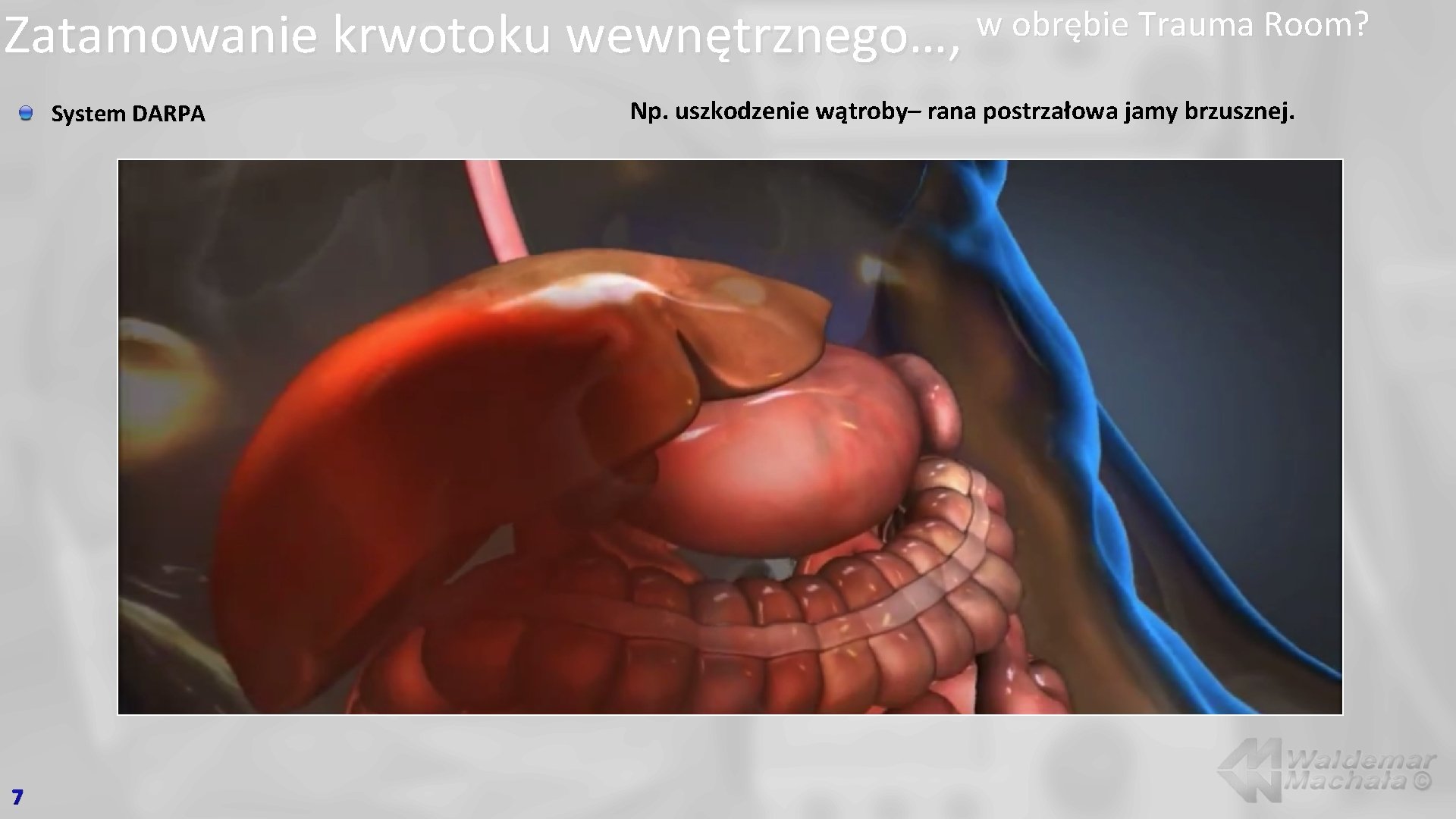 Zatamowanie krwotoku wewnętrznego…, System DARPA 7 w obrębie Trauma Room? Np. uszkodzenie wątroby– rana