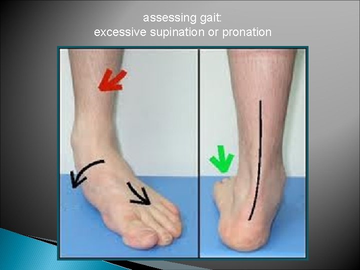 assessing gait: excessive supination or pronation 