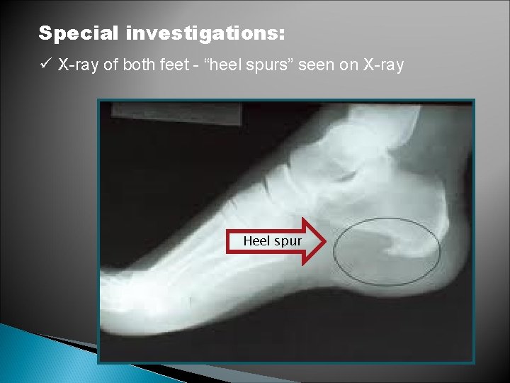 Special investigations: ü X-ray of both feet - “heel spurs” seen on X-ray Heel