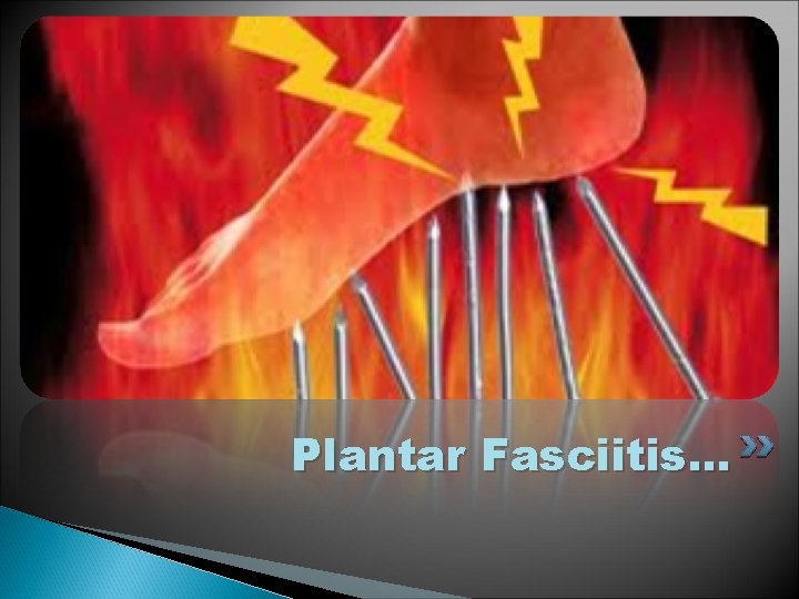 Plantar Fasciitis. . . 