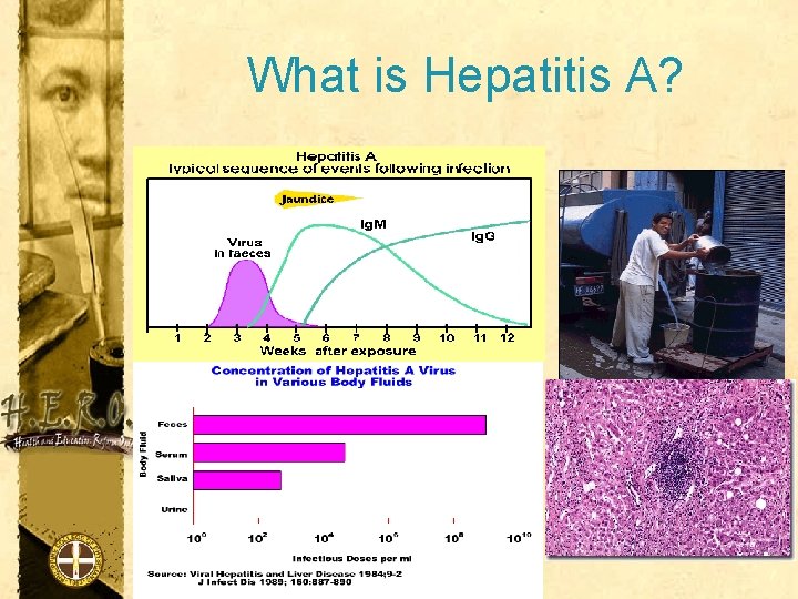 What is Hepatitis A? 