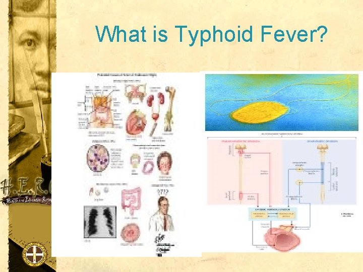 What is Typhoid Fever? 