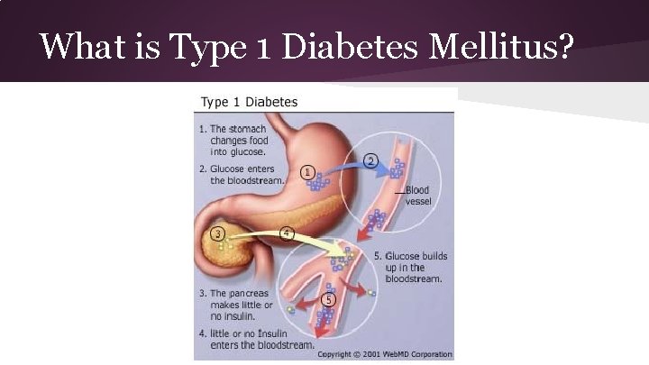 What is Type 1 Diabetes Mellitus? 