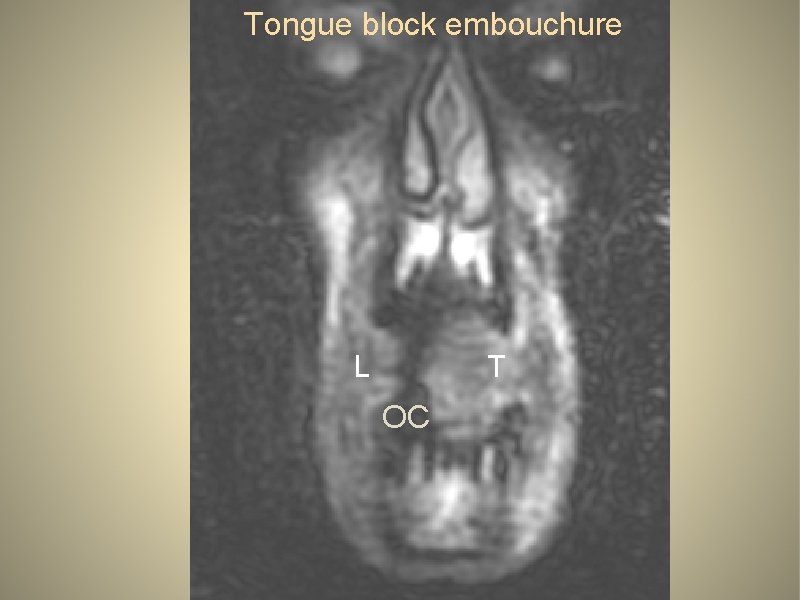 Tongue block embouchure L T OC 