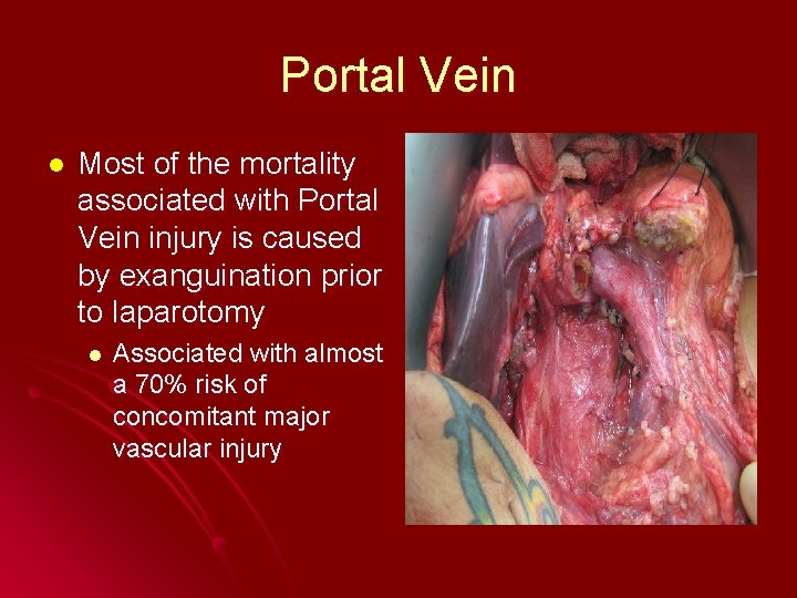 Portal Vein l Most of the mortality associated with Portal Vein injury is caused