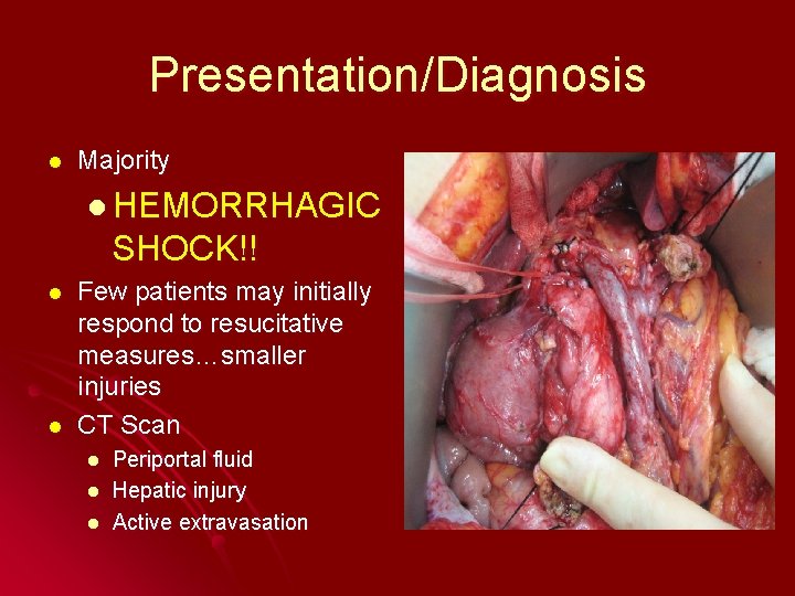 Presentation/Diagnosis l Majority l HEMORRHAGIC SHOCK!! l l Few patients may initially respond to