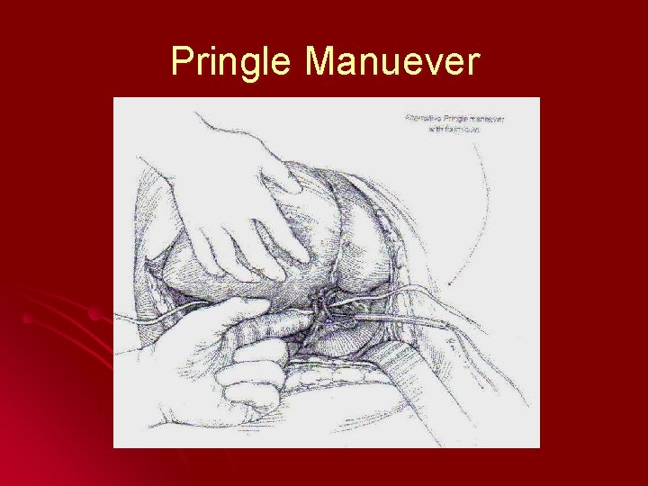 Pringle Manuever 