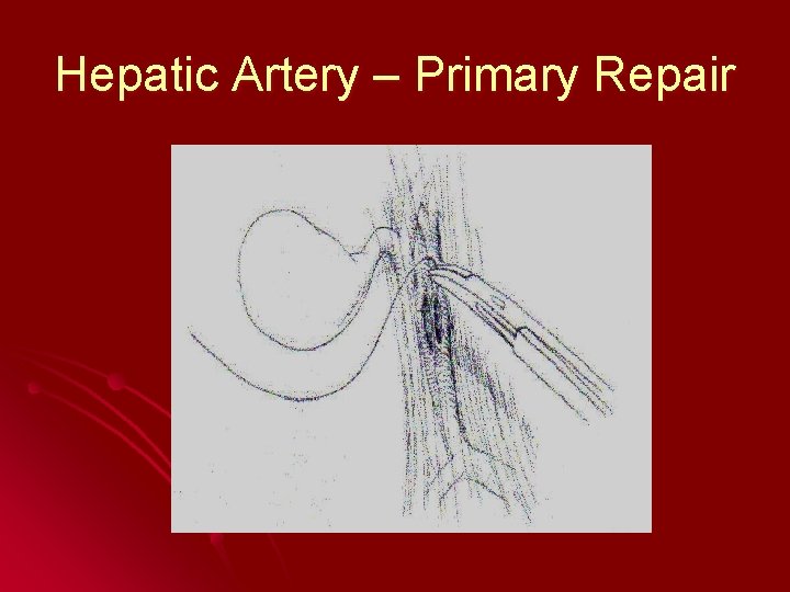 Hepatic Artery – Primary Repair 