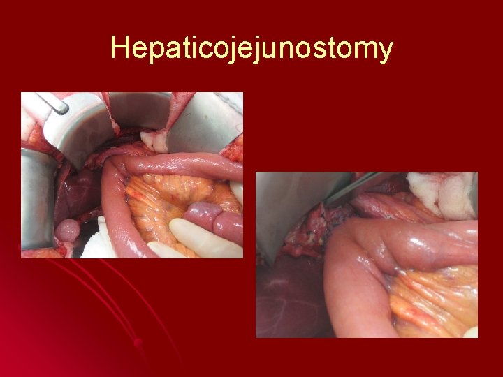 Hepaticojejunostomy 