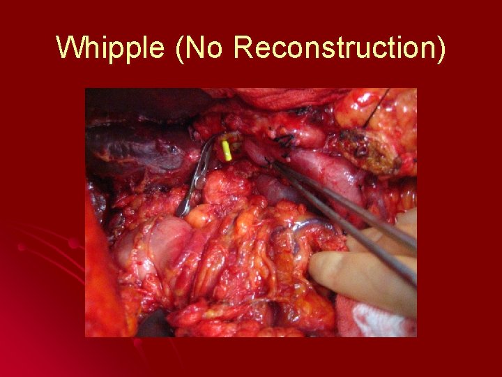 Whipple (No Reconstruction) 