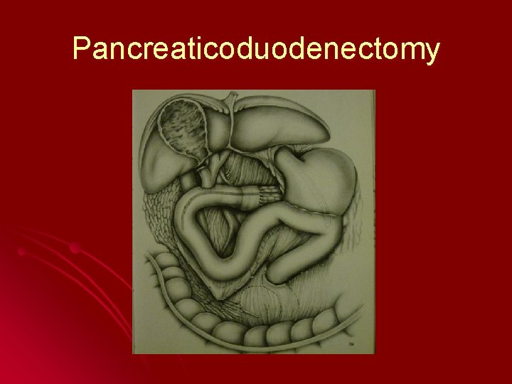 Pancreaticoduodenectomy 