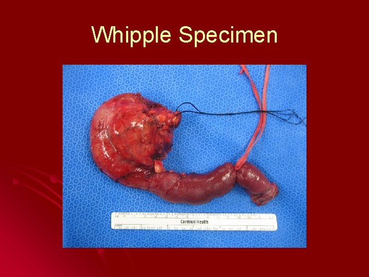 Whipple Specimen 