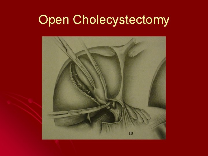 Open Cholecystectomy 