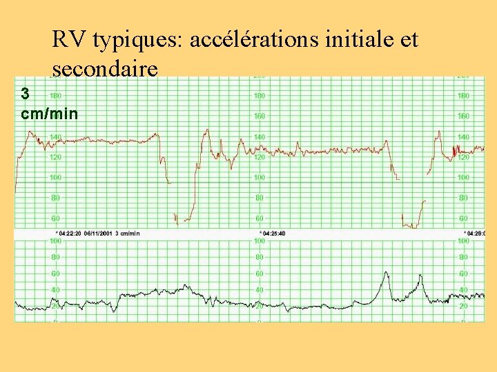 RV typiques: accélérations initiale et secondaire 3 cm/min 