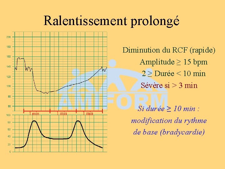 Ralentissement prolongé Diminution du RCF (rapide) Amplitude ≥ 15 bpm 2 ≥ Durée <