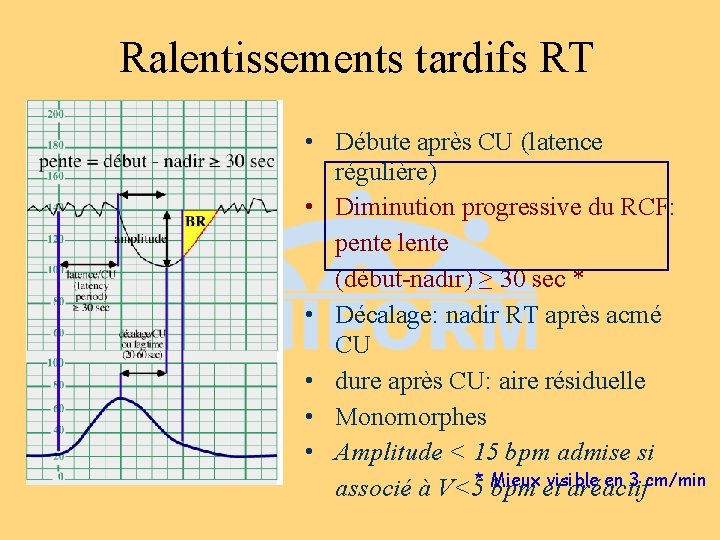 Ralentissements tardifs RT • Débute après CU (latence régulière) • Diminution progressive du RCF: