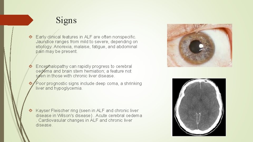 Signs Early clinical features in ALF are often nonspecific. Jaundice ranges from mild to