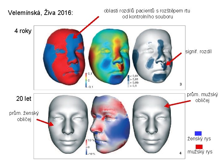 Velemínská, Živa 2016: oblasti rozdílů pacientů s rozštěpem rtu od kontrolního souboru 4 roky