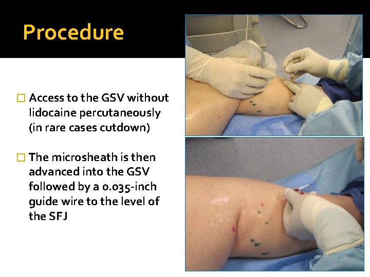 Procedure � Access to the GSV without lidocaine percutaneously (in rare cases cutdown) �