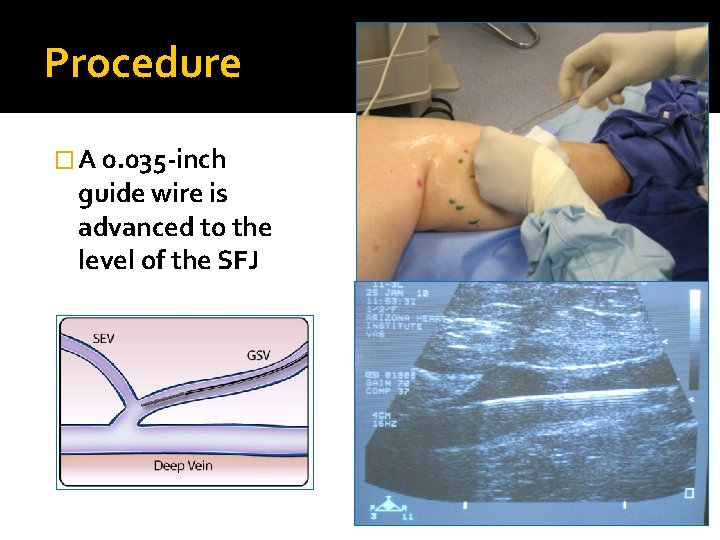 Procedure � A 0. 035 -inch guide wire is advanced to the level of